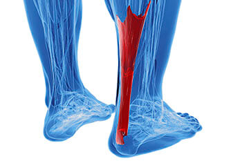 Achilles Tendonitis Treatment in the Martin County, FL: Stuart (Port Salerno, Palm City, Rio, North River Shores, Ocean Breeze, Jensen Beach, Hobe Sound, Sewall's Point) and Palm Beach County, FL: Jupiter (Tequesta, Juno Beach, Cabana Colony, Palm Beach Gardens, Jupiter Island, Lake Park, Riviera Beach) areas