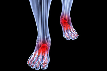 Arthritic foot and ankle care treatment in the Stuart, FL 34997 and Jupiter, FL 33458 areas