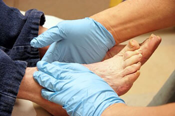 diabetic foot care in the Stuart, FL 34997 and Jupiter, FL 33458 areas