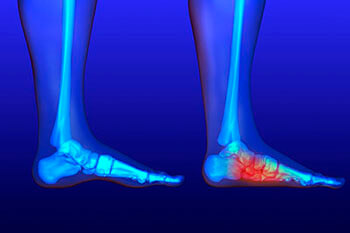 Flat Feet Treatment in the Martin County, FL: Stuart (Port Salerno, Palm City, Rio, North River Shores, Ocean Breeze, Jensen Beach, Hobe Sound, Sewall's Point) and Palm Beach County, FL: Jupiter (Tequesta, Juno Beach, Cabana Colony, Palm Beach Gardens, Jupiter Island, Lake Park, Riviera Beach) areas