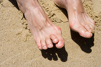 Hammertoes specialist in the Stuart, FL 34997 and Jupiter, FL 33458 areas