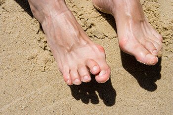 Hammertoes specialist in the Martin County, FL: Stuart (Port Salerno, Palm City, Rio, North River Shores, Ocean Breeze, Jensen Beach, Hobe Sound, Sewall's Point) and Palm Beach County, FL: Jupiter (Tequesta, Juno Beach, Cabana Colony, Palm Beach Gardens, Jupiter Island, Lake Park, Riviera Beach) areas