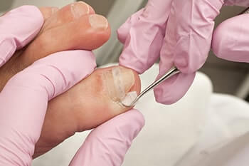 ingrown toenail in the Martin County, FL: Stuart (Port Salerno, Palm City, Rio, North River Shores, Ocean Breeze, Jensen Beach, Hobe Sound, Sewall's Point) and Palm Beach County, FL: Jupiter (Tequesta, Juno Beach, Cabana Colony, Palm Beach Gardens, Jupiter Island, Lake Park, Riviera Beach) areas