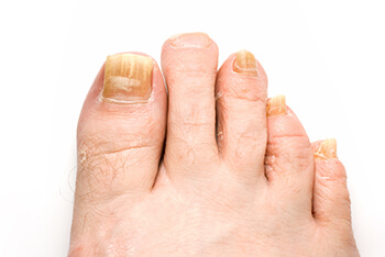 toenail fungus treatment in the Martin County, FL: Stuart (Port Salerno, Palm City, Rio, North River Shores, Ocean Breeze, Jensen Beach, Hobe Sound, Sewall's Point) and Palm Beach County, FL: Jupiter (Tequesta, Juno Beach, Cabana Colony, Palm Beach Gardens, Jupiter Island, Lake Park, Riviera Beach) areas