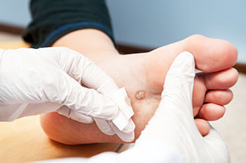 Plantar Warts Treatment in the Martin County, FL: Stuart (Port Salerno, Palm City, Rio, North River Shores, Ocean Breeze, Jensen Beach, Hobe Sound, Sewall's Point) and Palm Beach County, FL: Jupiter (Tequesta, Juno Beach, Cabana Colony, Palm Beach Gardens, Jupiter Island, Lake Park, Riviera Beach) areas