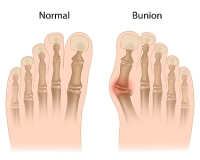 Understanding Bunion Symptoms