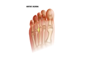 Symptoms of Morton's Neuroma