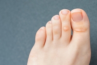 Understanding and Preventing Discomfort From Corns on the Feet