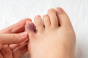 Common Causes and Care for a Broken Pinky Toe