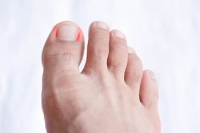 Causes and Treatments for an Ingrown Toenail