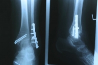 Stable vs Unstable Ankle Fractures