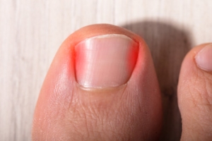 Podiatric Treatment for Ingrown Toenails