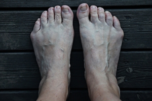The Painful Bump of a Bunionette