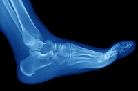 Signs of a Broken Foot