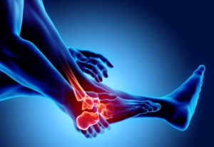 Am I at Risk for a Stress Fracture?