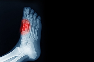 Treating Sesamoiditis
