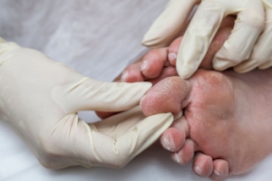 Foot Temperature Patterns in People With Diabetes and Nerve Damage