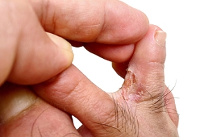 Types of Athlete's Foot