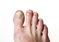 Who Is Prone to Developing Toenail Fungus?