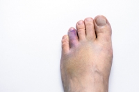 Foods to Eat or Not Eat With a Broken Toe