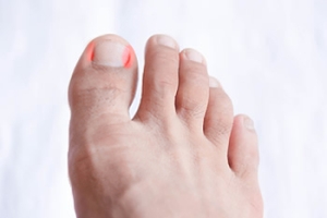 Possible Causes of Ingrown Toenails