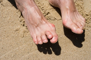 Hammertoe May Be Considered To Be A Muscle Imbalance