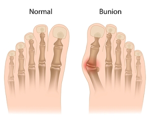 Deciding What to Do About a Bunion