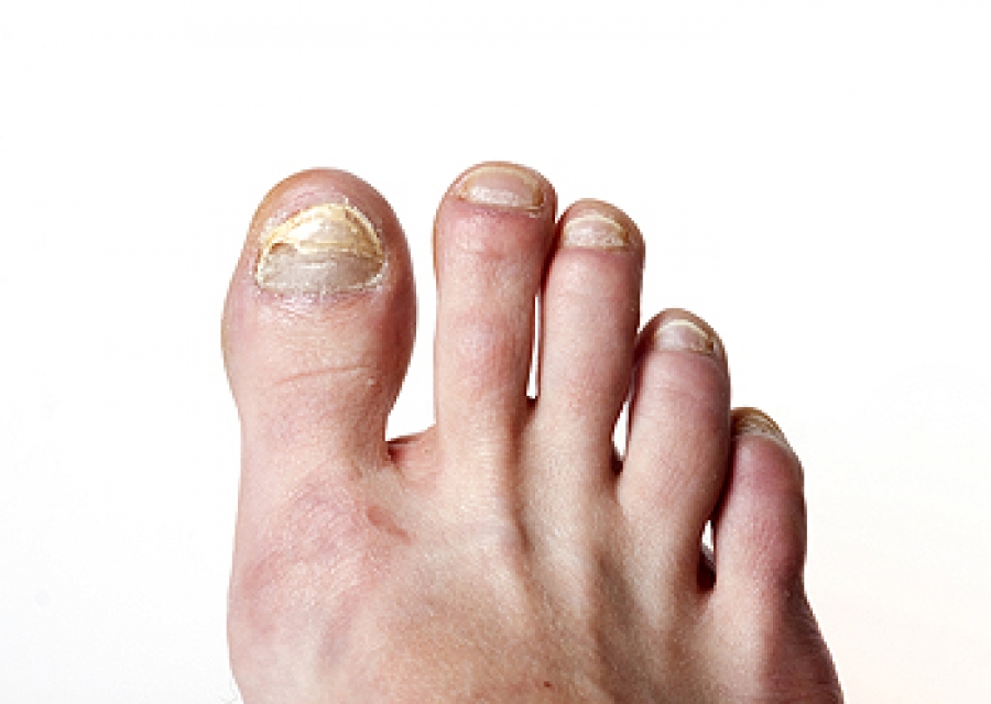 The Different Types of Toenail Fungus