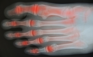 Treating Painful Symptoms of Rheumatoid Arthritis