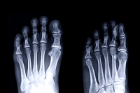 Two Common Stress Fractures Areas